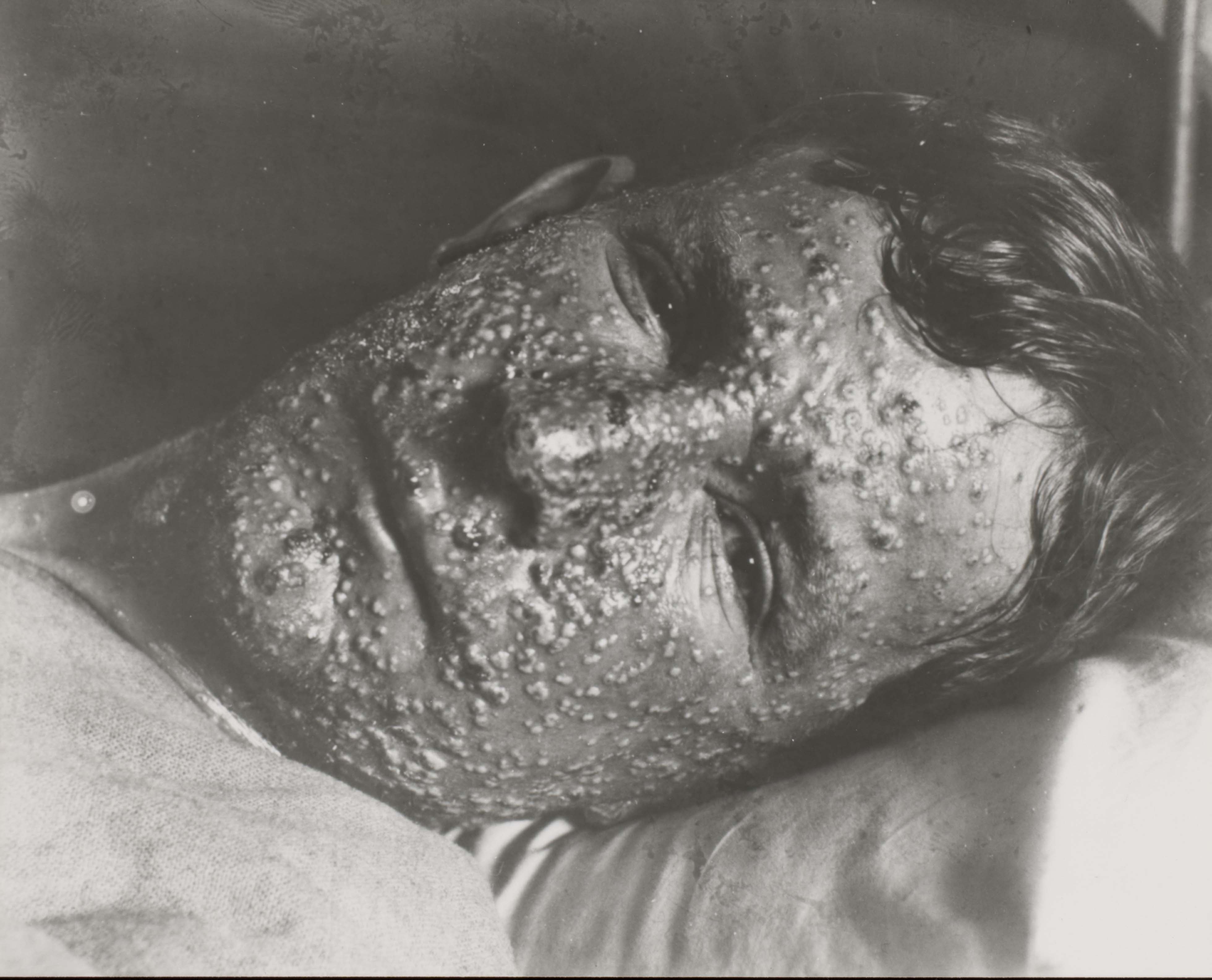 <p>Photograph of the face of a smallpox patient</p>
